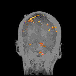 让传感器动起来 我国科研团队研发出脑机接口动态电极